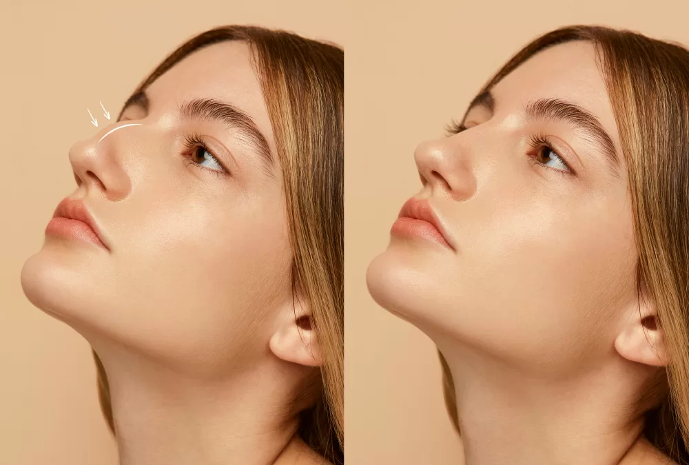 Nonsurgical Rhinoplasty Before and After