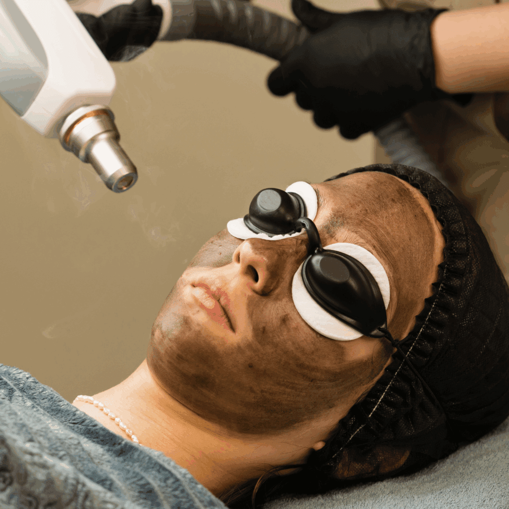Carbon Facials