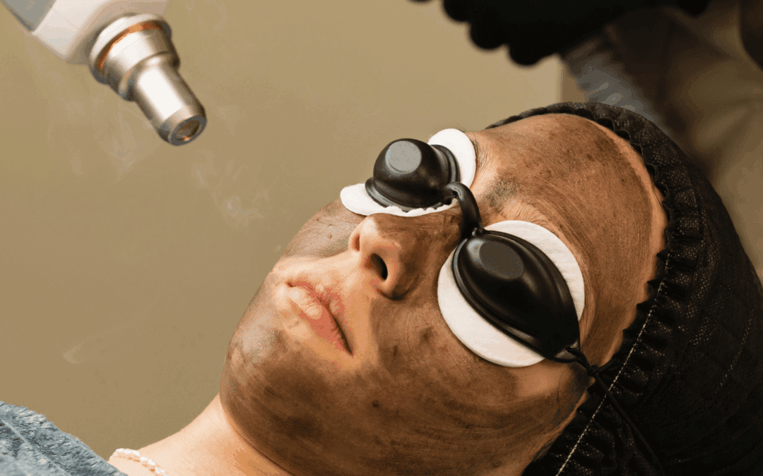 Carbon Facial