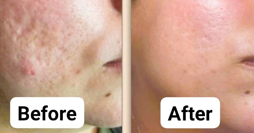Mesotherapy Before and After