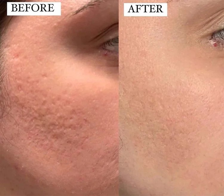 Microneedling Before and After