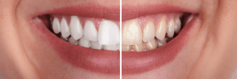 Benefits of Teeth Whitening Treatment
