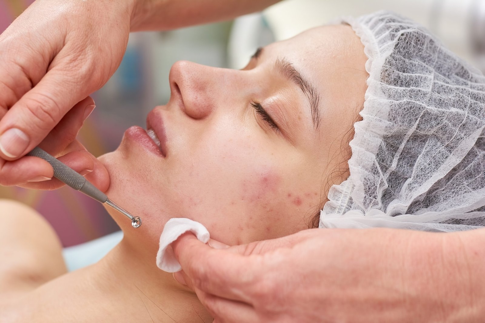 Skin Tag Removal
