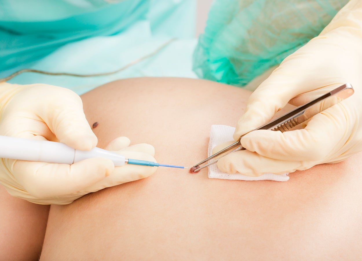 Skin Lesions Removal