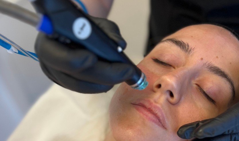 Hydrafacial for Hyperpigmentation