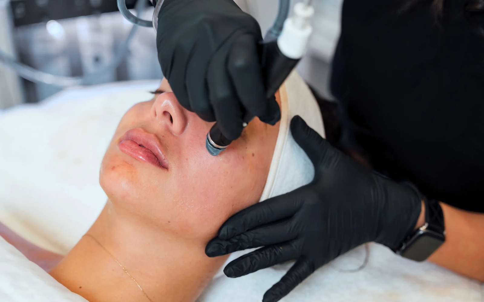 Hydrafacial for Acne