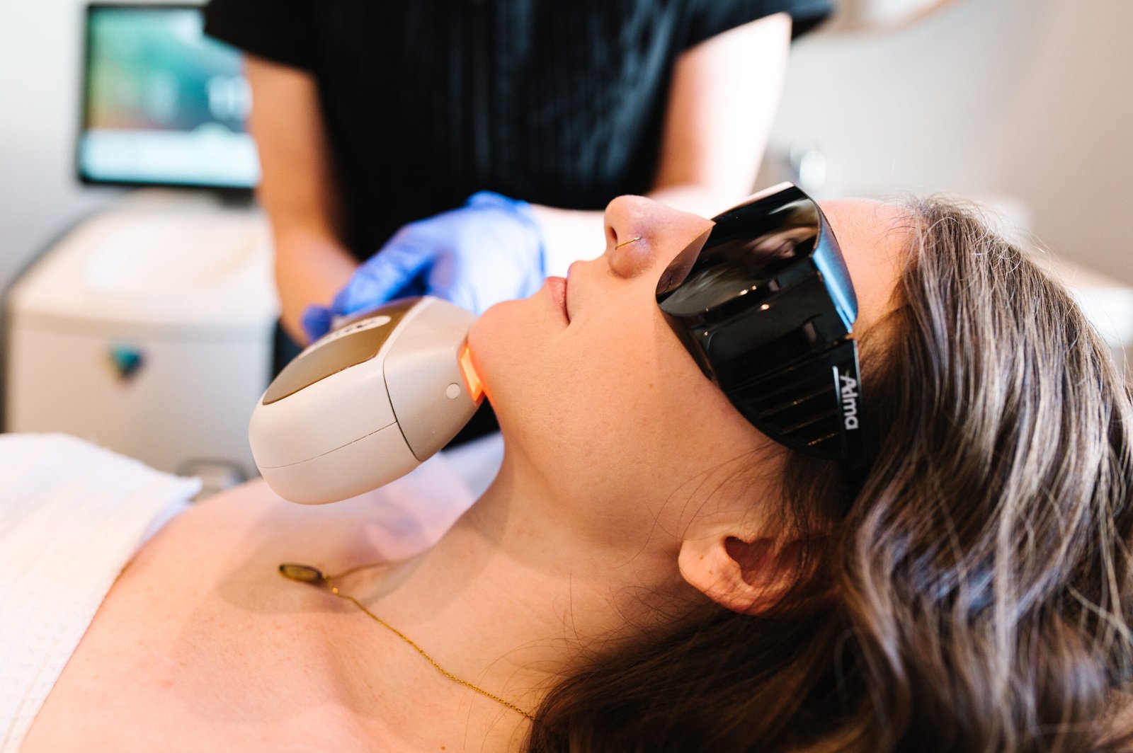 Chin Laser Hair Removal