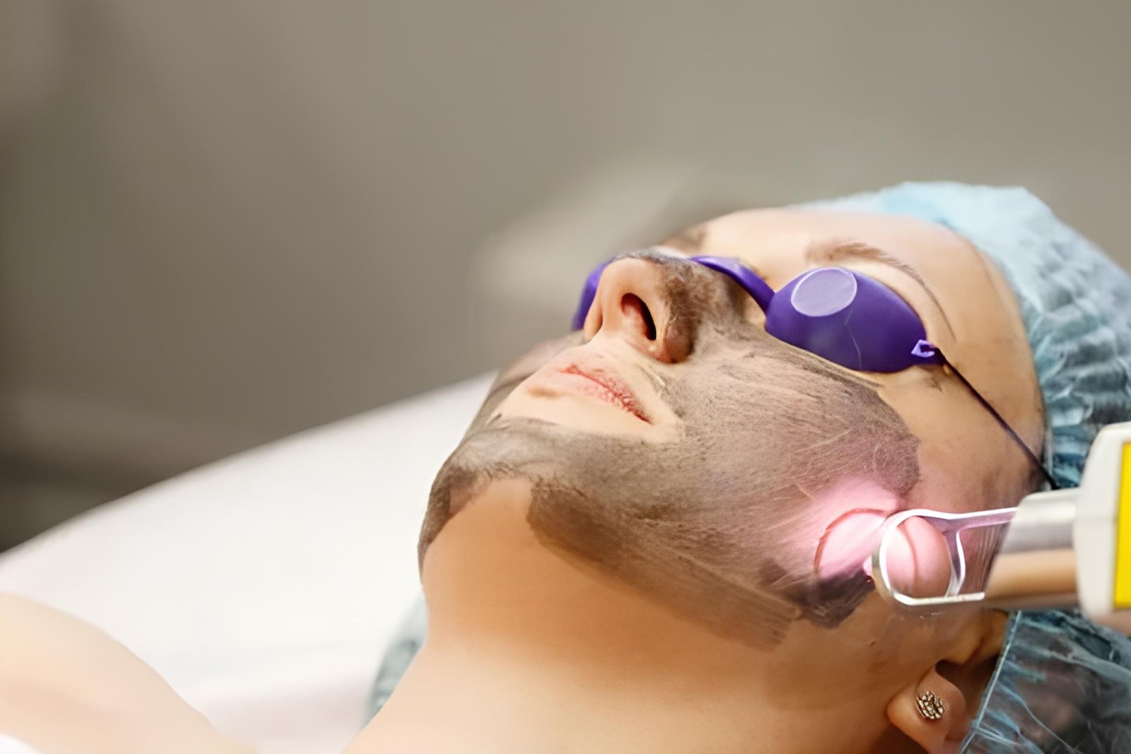 carbon facials