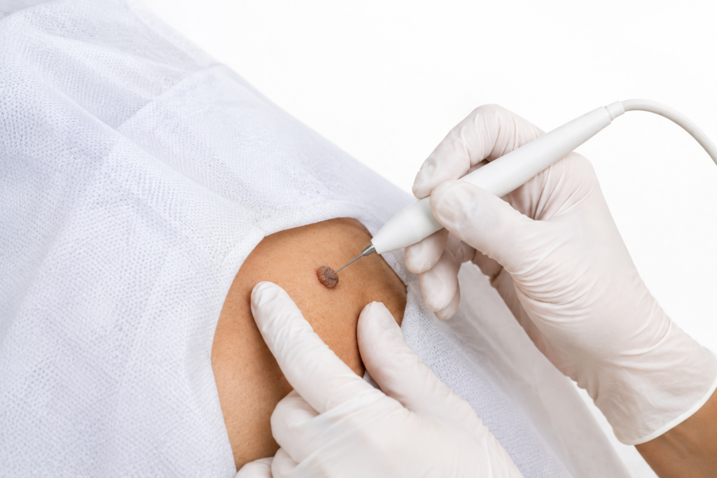 Skin Lesion Removal​ aesthetic Ilford